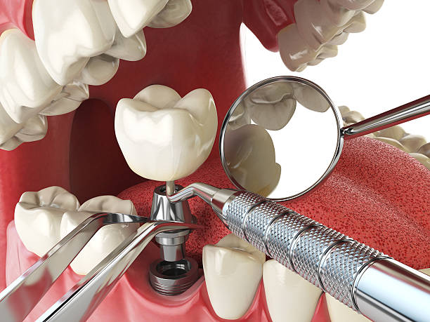 Best Emergency Denture Repair in Bude, MS